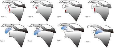 Possibility of diagnosing rotator cuff tears in areas with scarce medical resources: can non-standard anteroposterior radiographs accurately predict rotator cuff tears?